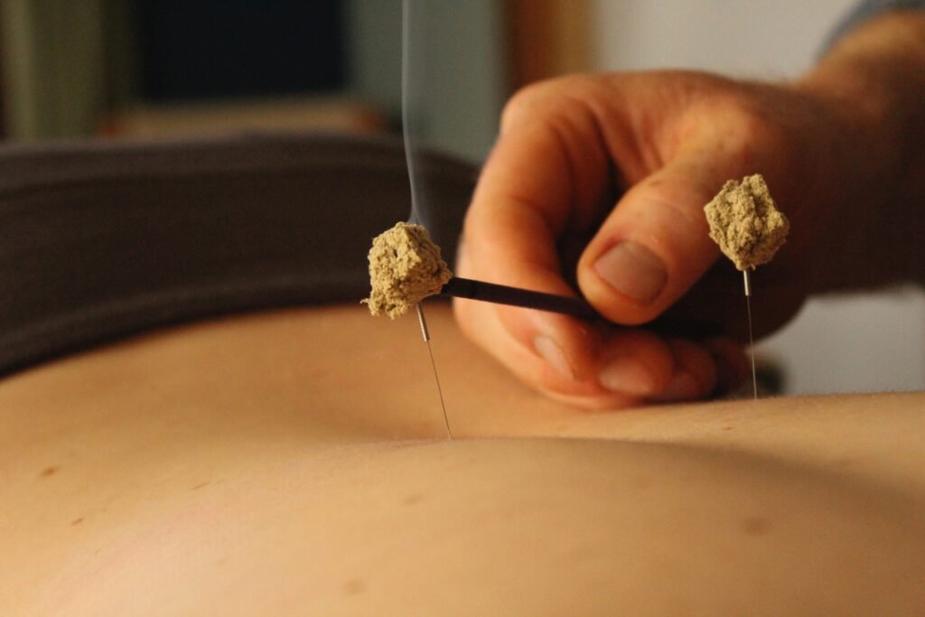 Lighting moxabustion on top of an acupuncture needle